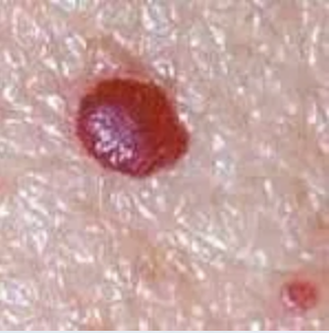 Cherry angioma before cryotherapy treatment